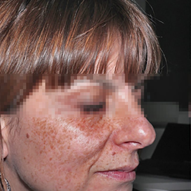 Caucasian Skin_before-01