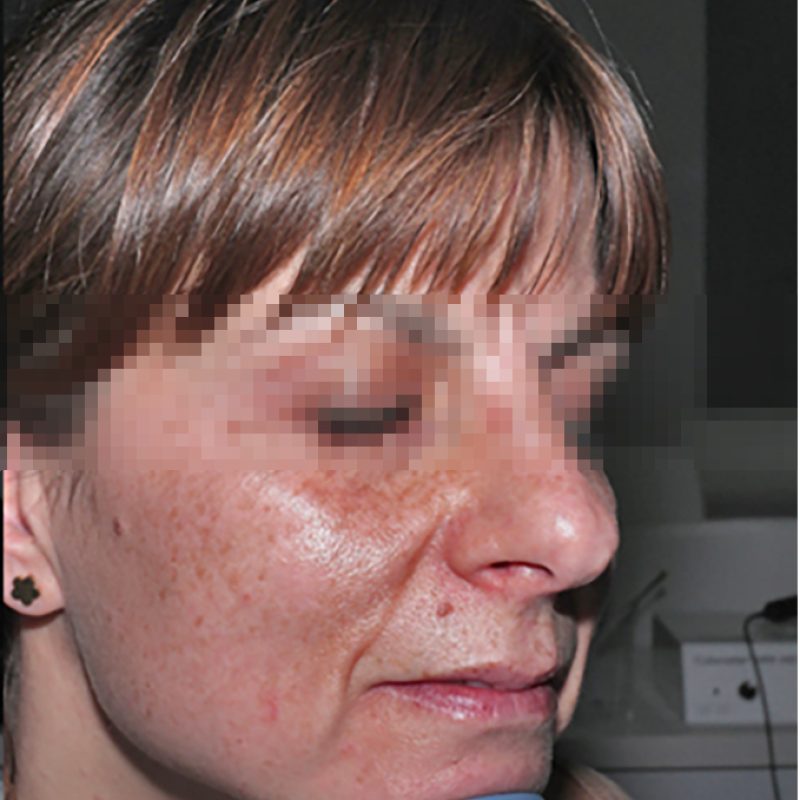Caucasian_after-01