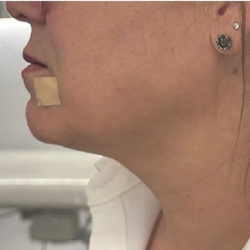 Lipolytic Adipozon 💉 est une nouvelle technique de lipolyse qui permet d’éviter les effets seco (1)