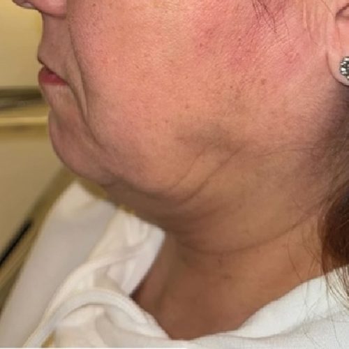 Lipolytic Adipozon 💉 est une nouvelle technique de lipolyse qui permet d’éviter les effets seco